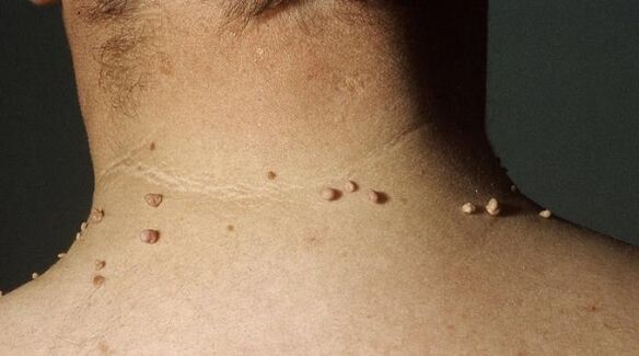 Papilloma nyakon kezelese. Miért jelenik meg a HPV?